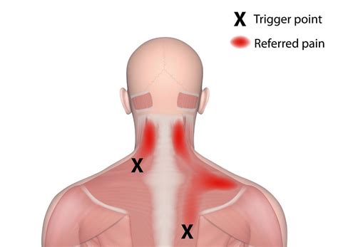 role  central sensitization  myofascial pain syndrome el paso