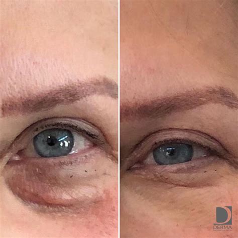 PRP Platelet Rich Plasma — Derma Medical Spa