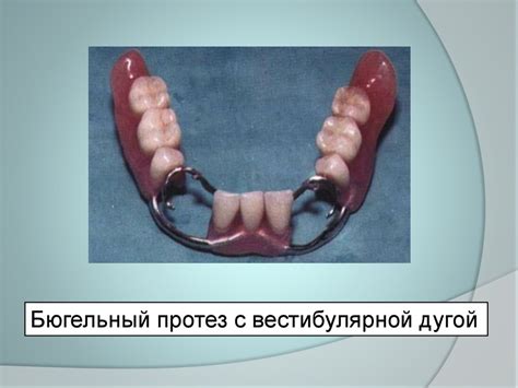 Бюгельный протез - презентация онлайн