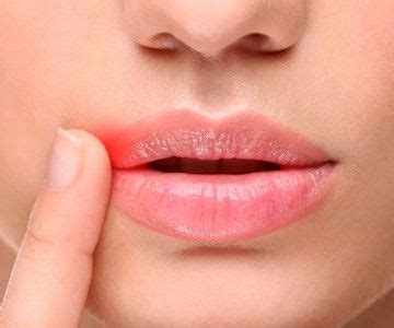Заеды в уголках рта: как быстро избавиться | Губы, Уход за губами ...