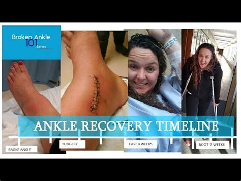 Ankle Recovery Timeline - Broken Ankle 101 - covering the timeline of ...