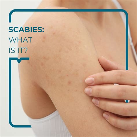 Beginning Stages Of Scabies Scabies Symptoms And Treatment