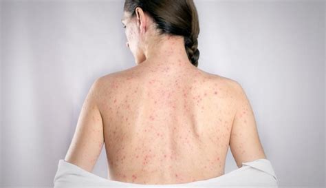 Are Sciatica and Shingles Related?