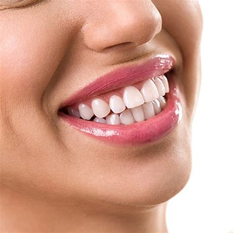 Porcelain Veneers Lakeshore, Ontario, Canada - Emeryville Family Dental