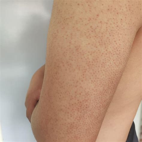 chicken skin  arms