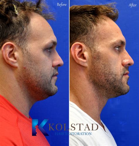 Hair Transplant San Diego Case 15 | Kolstad Hair Restoration