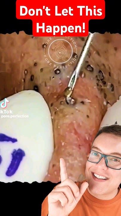 Unbelievable Blackhead Removal 2024: Don't Make This One Mistake! - o8v0262
