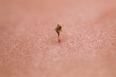 Bee Stinger In Skin