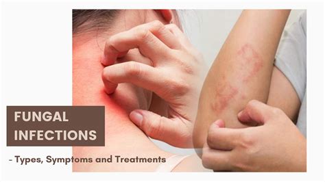 fungal infection symptoms stages  fungal infection onlymyhealth