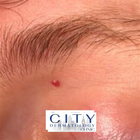 Cherry Angioma Removal in London from £275 | Same Day Treatment