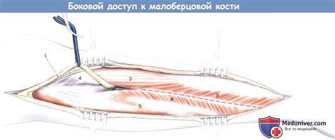 Техника бокового доступа к малоберцовой кости