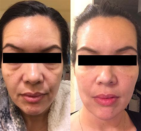 circles  eyes  solutions  vermont facial aesthetics