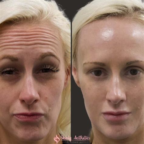 Botox Before and After: Dramatic Results and What to Expect - Must Read ...