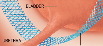 The Bladder Sling: Everything you need to know