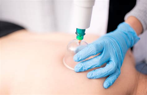 What Is Cupping Therapy? Benefits and Applications | USAHS