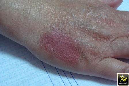 Érythème récidivant et fixe. - DermatoMaroc