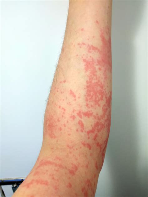 117 best r/urticaria images on Pholder | I cant anymore