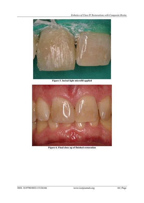 Esthetics of Class IV Restorations with Composite Resins | PDF