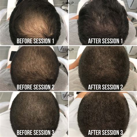 Scalp micro-pigmentation will soon complement men's haircuts for balding hair 21