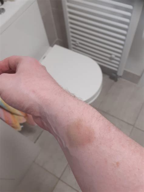 Does this bruise look normal after 5 days? : r/SelfHarmScars