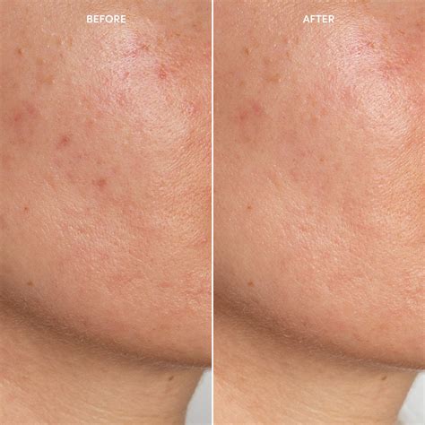 Anti-Blemish System