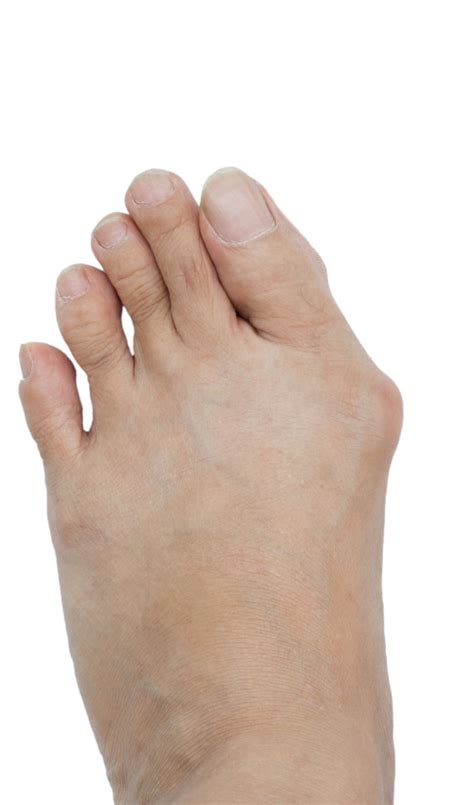 Best Bunion Corrector Sandals. Other Treatments for Bunions – Bilt Labs