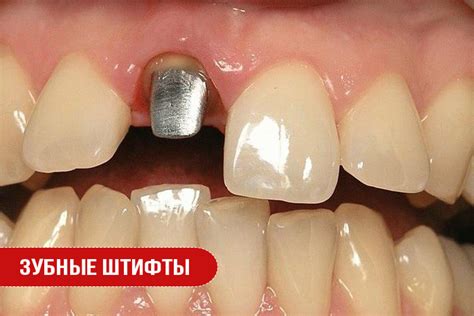 Что такое штифт: виды, назначение и применение