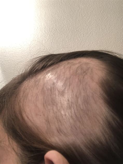 857 best Alopecia Areata images on Pholder | Alopecia Areata, Female