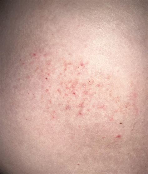 Does this look like scabies? I had it one year ago and it was similar