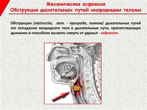 Механическая асфиксия. Обструкция дыхательных путей инородными телами ...