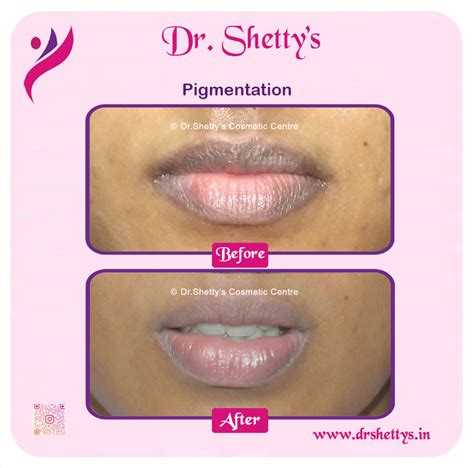 lip lightening laser
