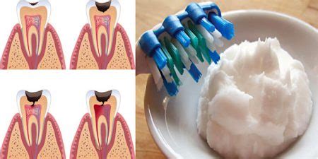 This Is How You Reverse Cavities And Tooth Decay Naturally Without ...