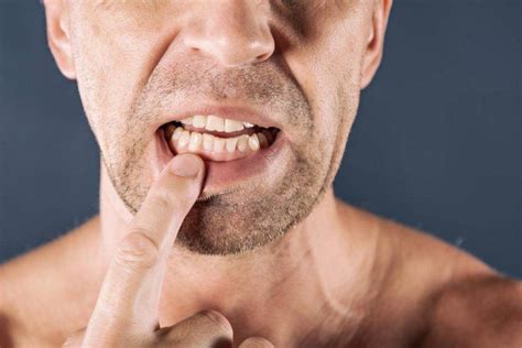 Best Home Remedies for Swollen Gums – Sabka Dentist – Top Dental Clinic ...