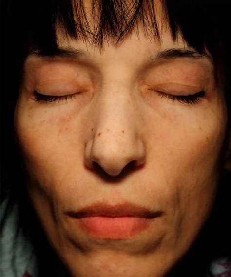 Kilmore Cosmetic Clinic: Skin Peels for Renewed Radiance