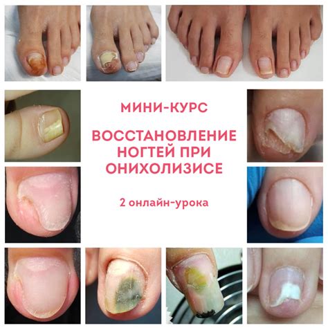 ВОССТАНОВЛЕНИЕ НОГТЕЙ ПРИ ДИСТРОФИЯХ: ОНИХОЛИЗИС, ОНИХОРЕКСИС И ДРУГИЕ