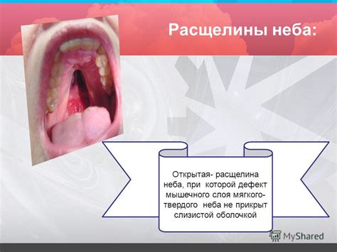 Презентация на тему: "Врожденные расщелины мягкого неба. Сабмукозная ...