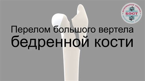 Авульсионный перелом большого вертела бедренной кости - YouTube