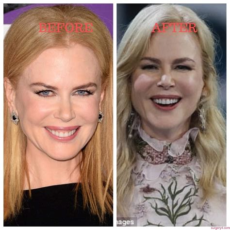 Unveiling The Truth Behind Nicole Kidman's Plastic Surgery Journey