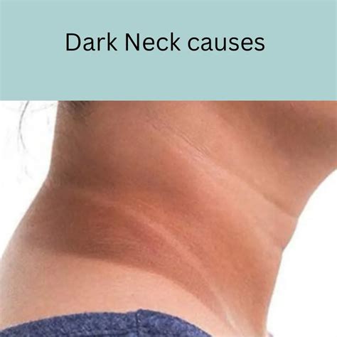 Dark neck causes | black neck | causes | treatment | araah