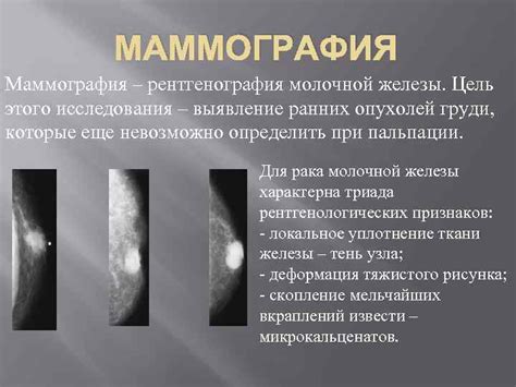 РАК МОЛОЧНОЙ ЖЕЛЕЗЫ У МУЖЧИН