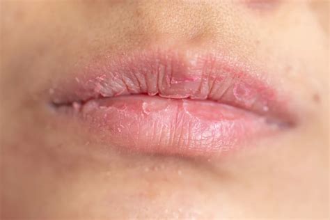lips rejuvenation clinic  malaysia nextmed clinic