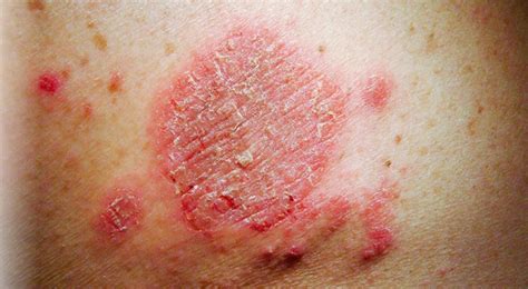SKIN RASH CAUSES, HOW TO MANAGE AND POSSIBLE TREATMENT