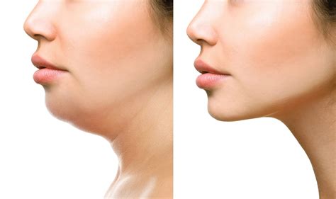 how to get rid of fat under chin 8