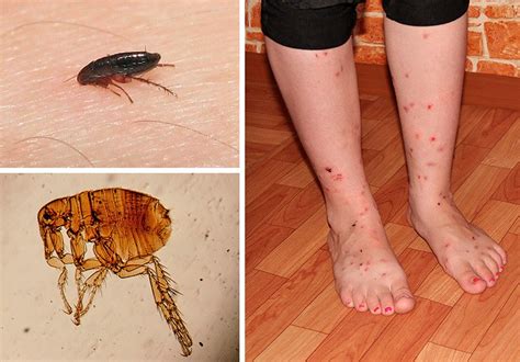 Укусы блох: симптомы, как выглядят, опасность и лечение в домашних условиях