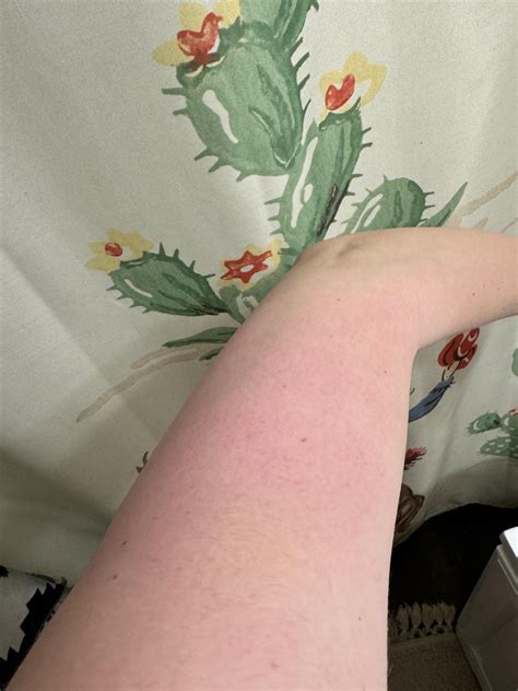 Red, bumpy upper arms : r/30PlusSkinCare