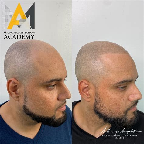 Professional Scalp Micropigmentation in Wethersfield, CT