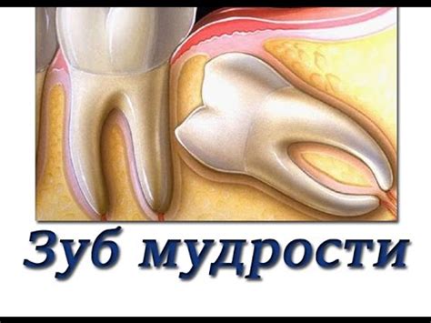 Что делать если болит зуб мудрости. Лечение воспаления зуба мудрости ...