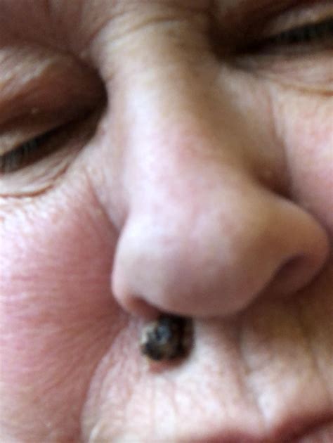 Small dry patch on face : r/DermatologyQuestions