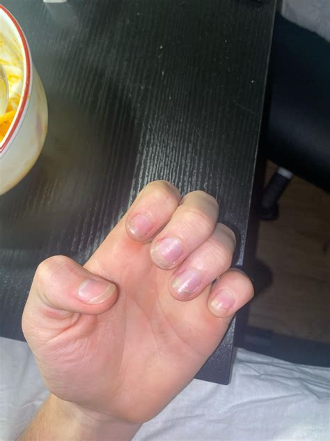 How do I grow my nail bed : r/nailbiting