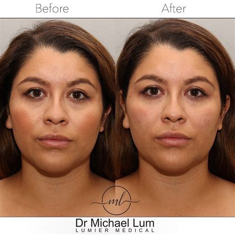 Hollows Under Eyes - Lumier Medical